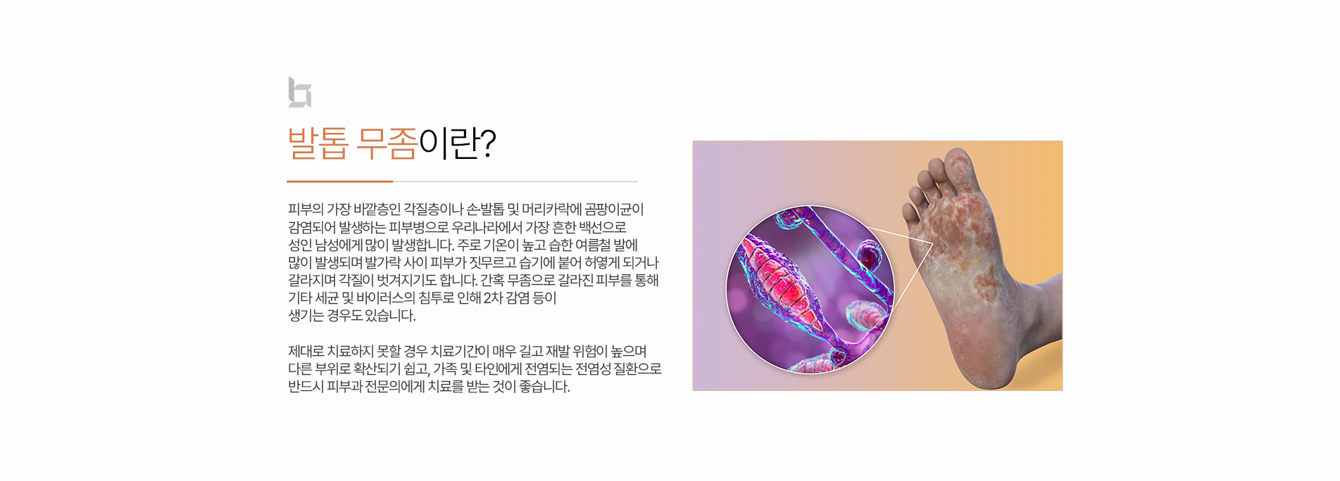 발톱무좀 소개